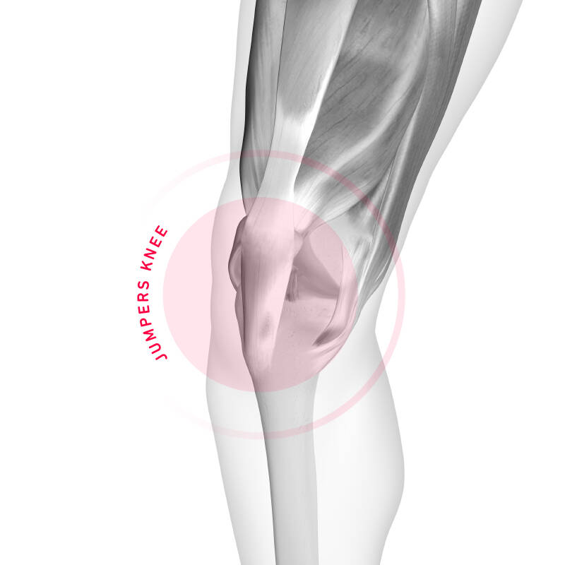 Schematische weergave van het pijngebied in een knie -knie