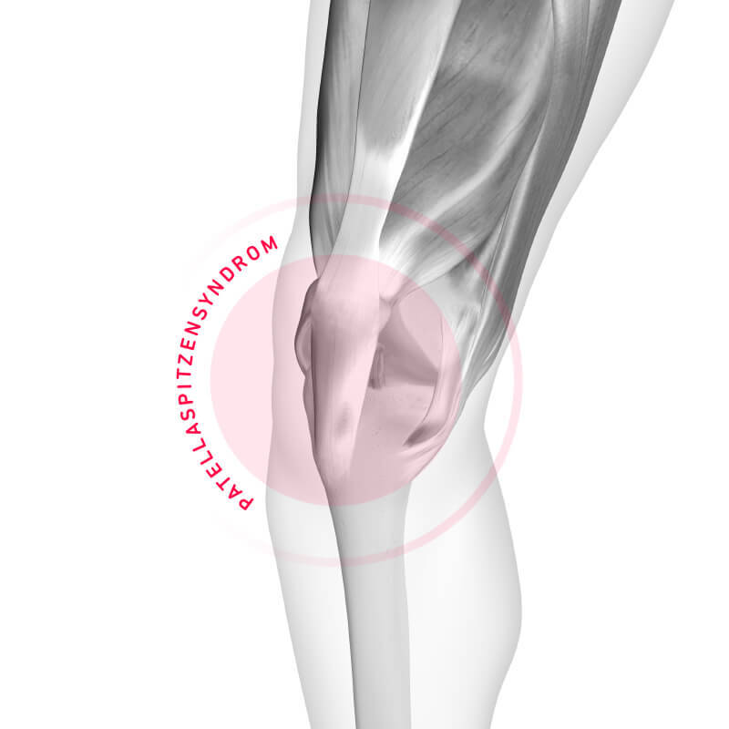 Patellaspitz -syndroom als de oorzaak van kniepijn tijdens het rennen Schematische weergave van het patella -tipsyndroom