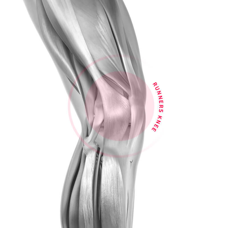 Schematische weergave van het pijnlijke gebied met een knie