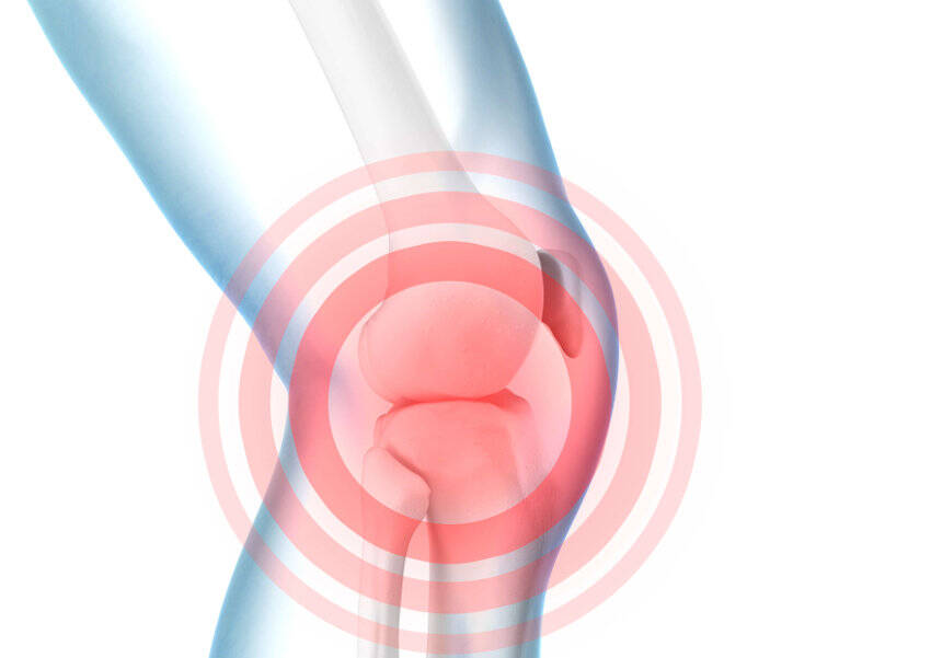 Schematische weergave van kniepijn op een model van het kniegewricht